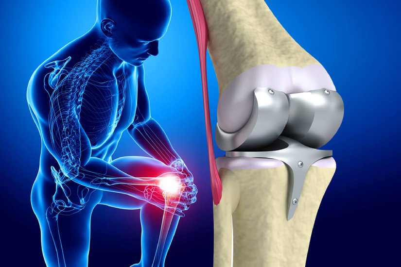 Artroplasti (Protez) Rehabilitasyonu